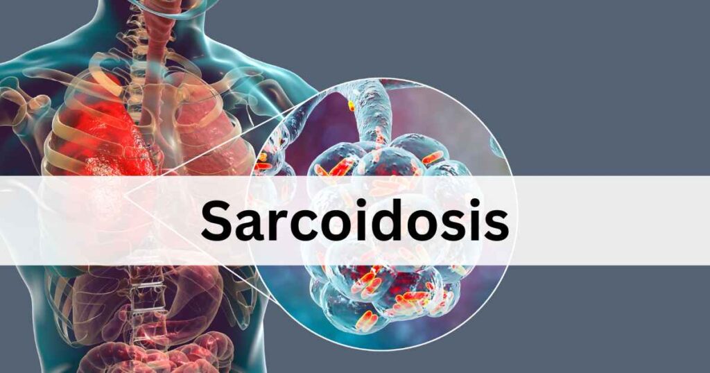 A slide titled "Sarcoidosis" displaying a semi-transparent human torso with highlighted granulomas.